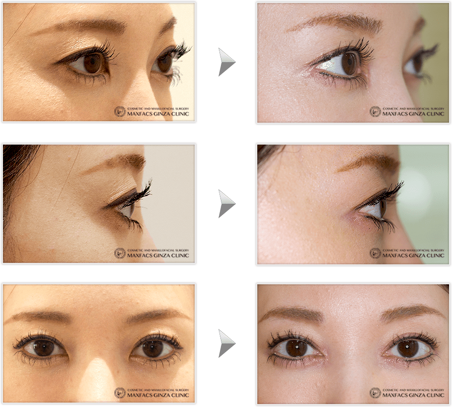 目尻切開と目頭切開 その2 マックスファクス銀座クリニック ブログ
