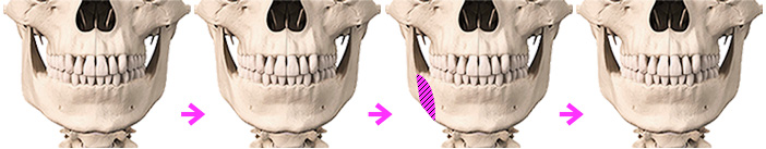 下顎角形成術 / 外板切除術